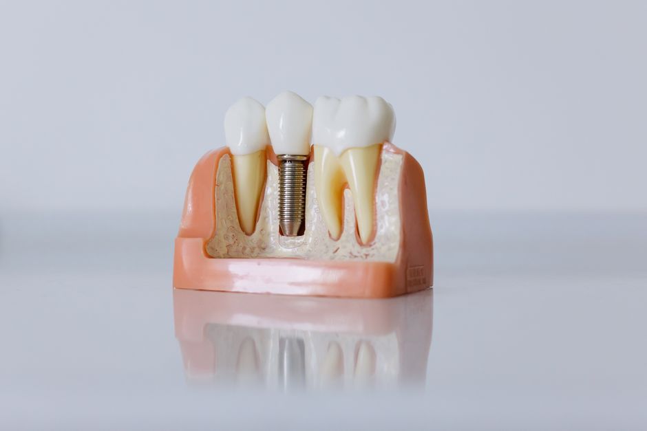 E-book Implantul dentar